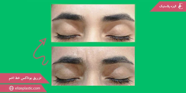 Botox-injections-for-frown-lines