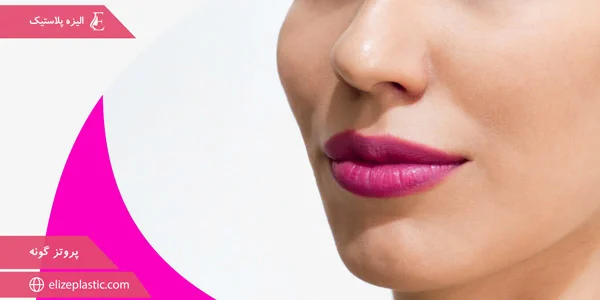 cheek-prosthesis