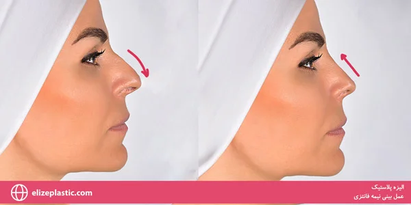 Semi-fantasy-nose-job